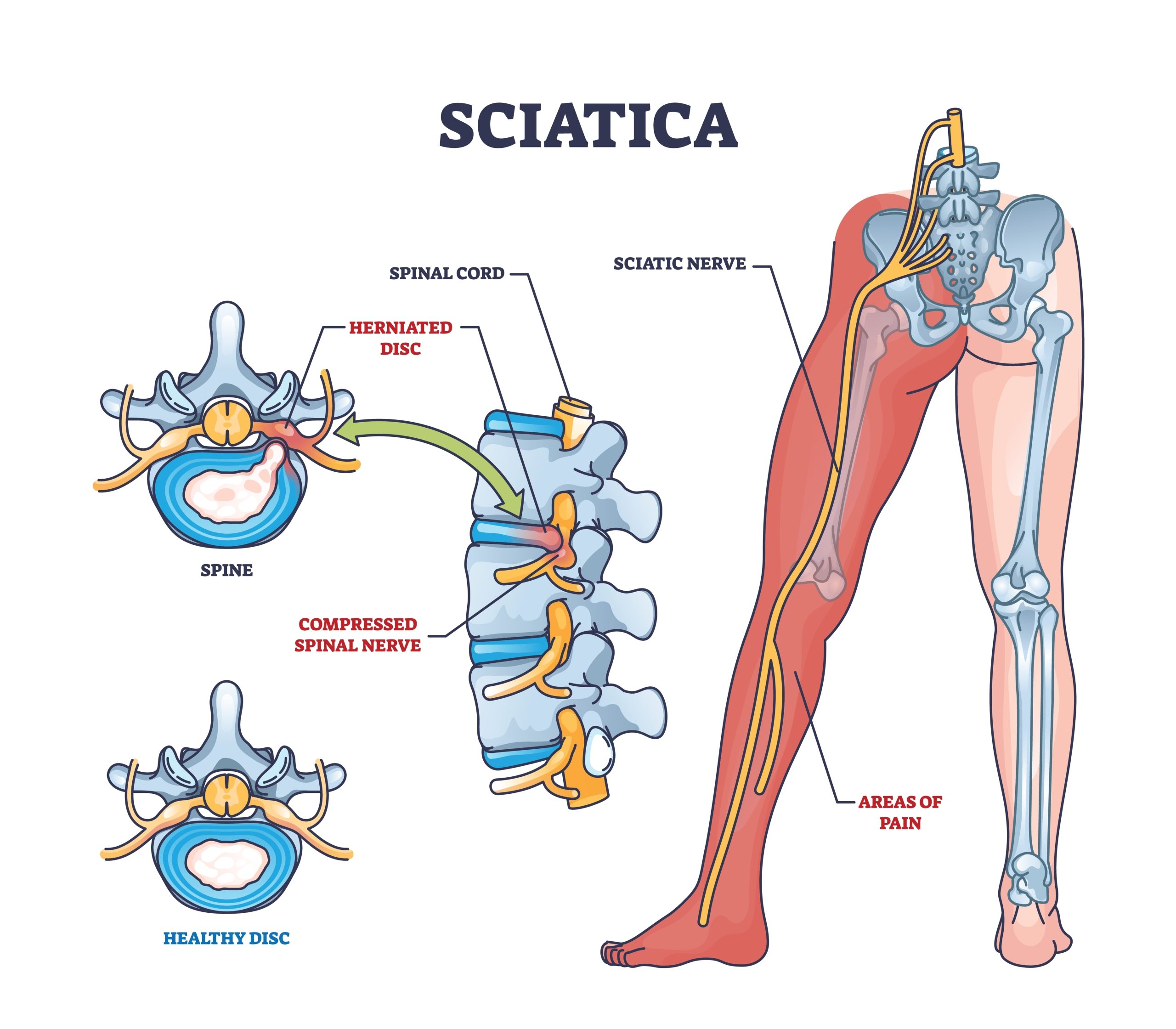 Sciatica treatment Chandigarh Mohali PhysioNutra
