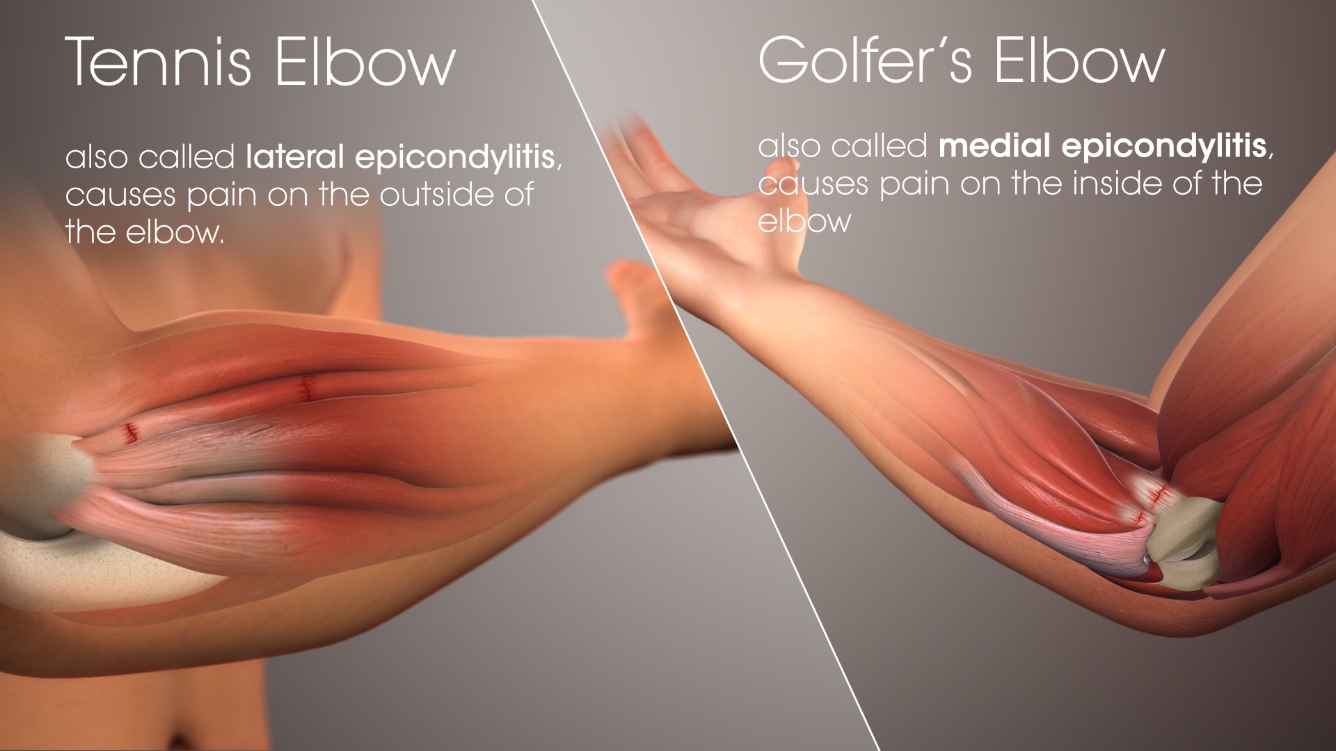 Sports injury ACL tennis elbow treatment Chandigarh Tricity